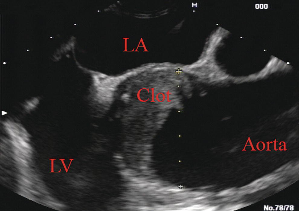 Photo depicts a linear array image showing the aortic root with clot due to an unsuspected aortic dissection.