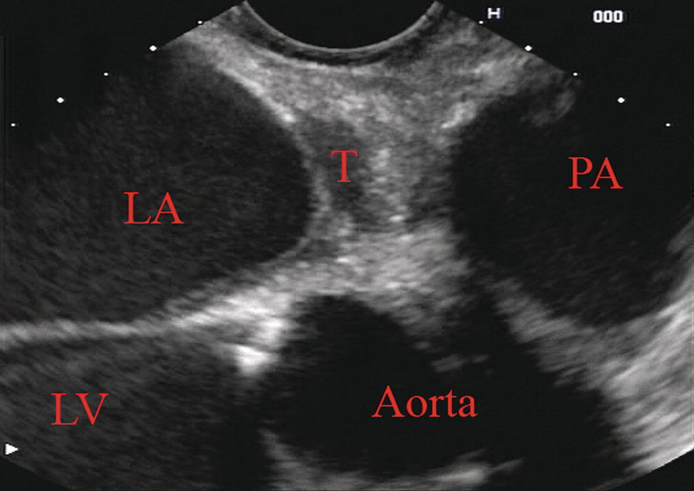 Photo depicts a linear array image of a metastasis (T) from breast cancer to the left atrial myocardium.