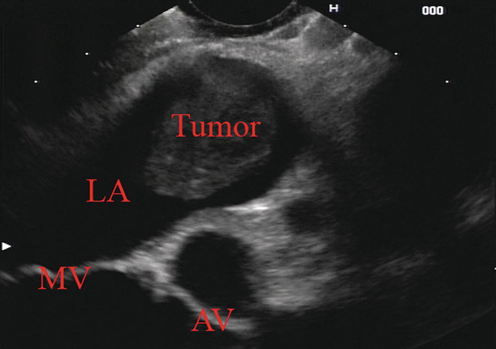 Photo depicts a linear array image of a rhabdomyosarcoma infiltrating into the left atrium (LA). The mitral valve (MV) and aortic valve (AV) are shown.