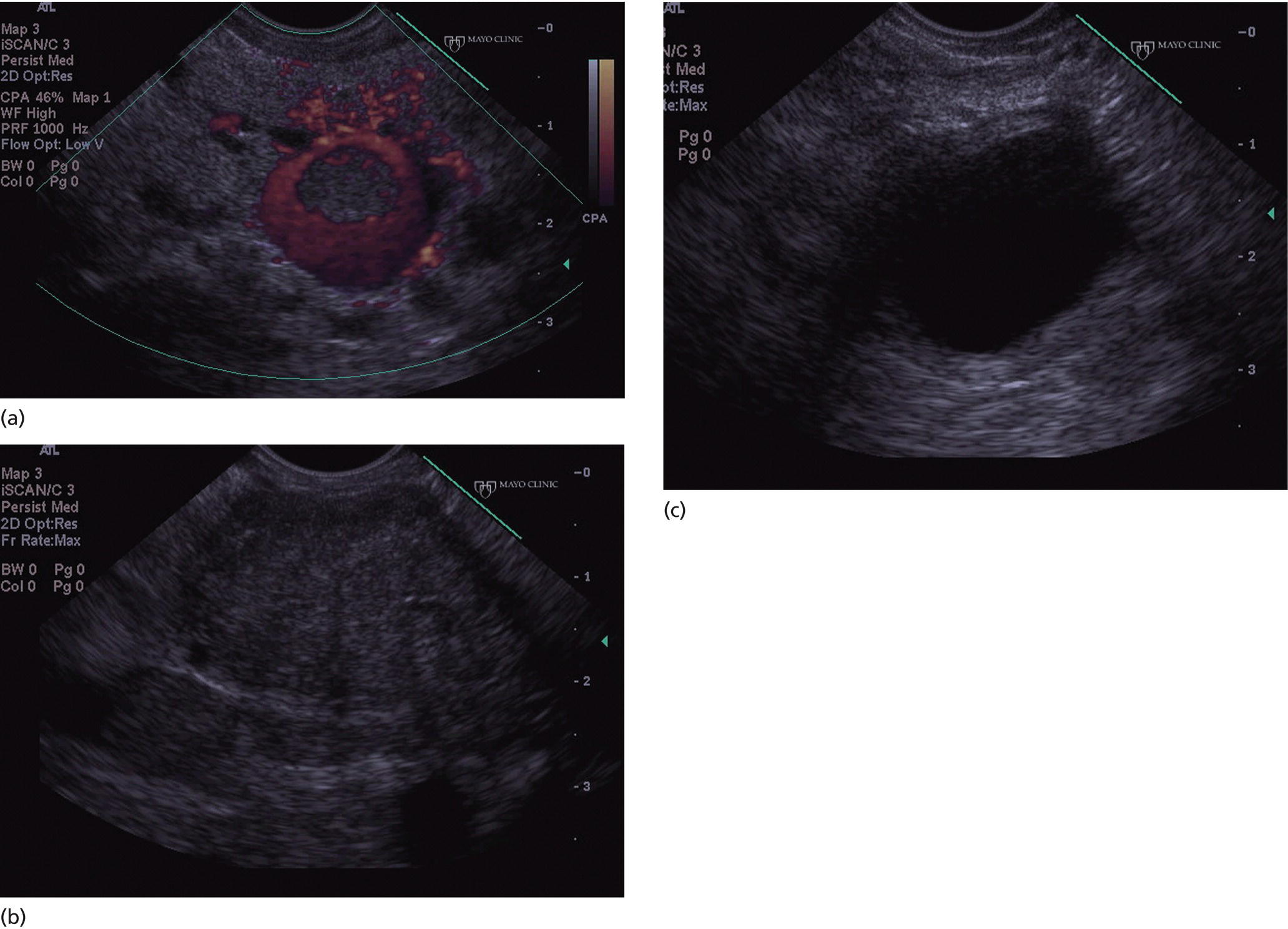Photos depict images obtained from a patient with a gastrinoma following helical computed tomography (CT) that revealed a pancreatic cyst that was not felt to represent a gastrinoma.