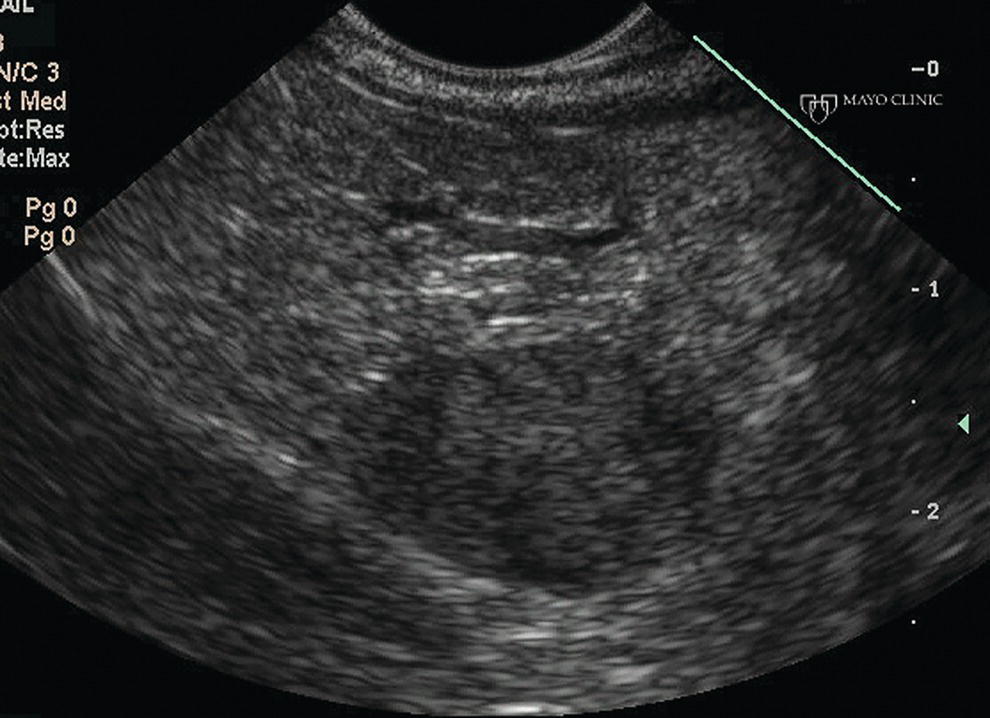 Photo depicts following a negative computed tomography (CT) to search for a presumed insulinoma, linear endoscopic ultrasound identified the insulinoma within the pancreatic body, allowing curative surgical intervention.