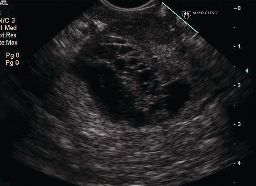 Photo depicts endoscopic ultrasound revealed a large well-circumscribed hypoechoic lesion that contained solid and cystic components with the diagnosis of a solid pseudopapillary tumor established by endoscopic ultrasound-guided fine needle aspiration (EUS-FNA) and later confirmed at surgery.