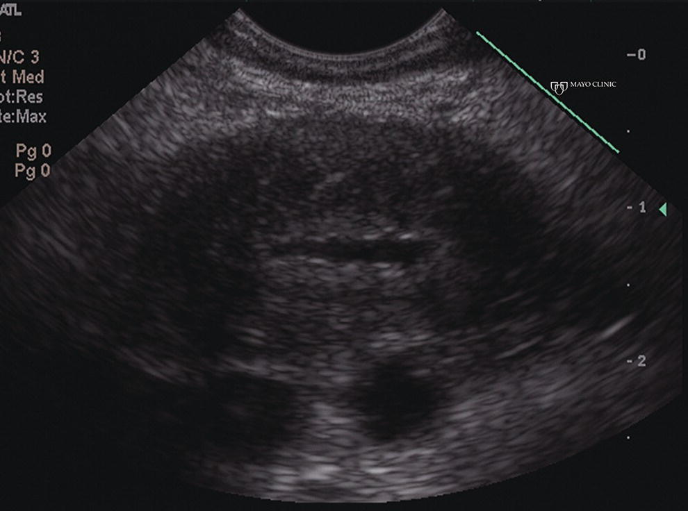 Photo depicts classic endoscopic ultrasound appearance of autoimmune pancreatitis including hypoechoic diffuse pancreatic enlargement with hypoechoic, coarse, patchy, heterogeneous parenchyma.