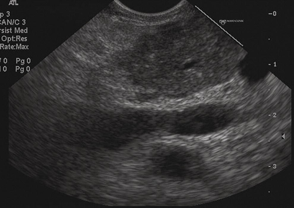 Photo depicts almost classic endoscopic ultrasound appearance of autoimmune pancreatitis with a hypoechoic and enlarged gland without the prominent coarse, patchy, heterogeneous changes.