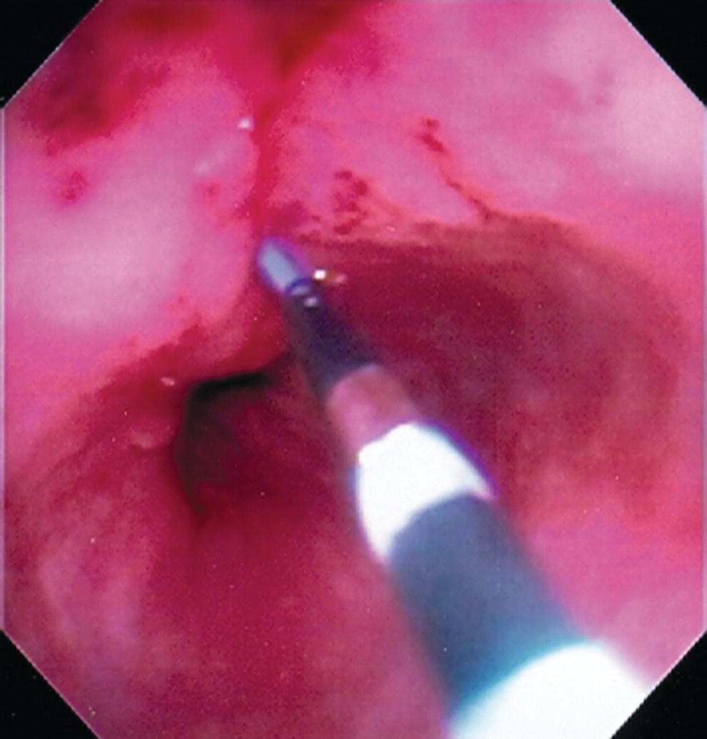 Photo depicts the transmural tract is dilated using a 5-Fr endoscopic retrograde cholangiopancreatography (ERCP) cannula.