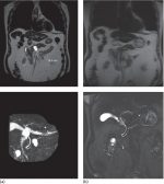 How to do EUS‐guided Pancreatic Cyst Chemoablation