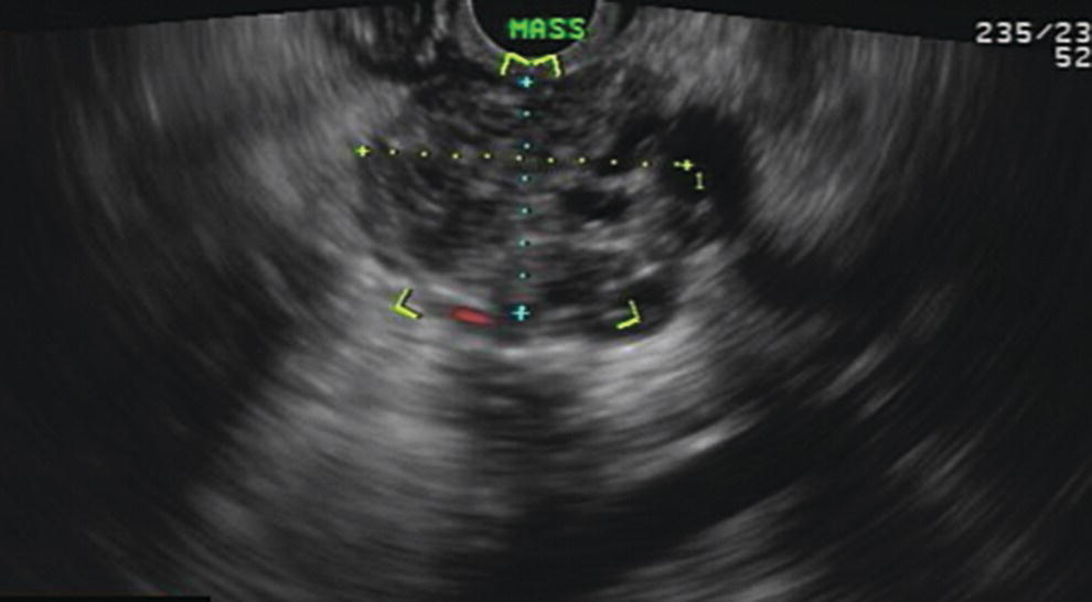 Photo depicts hypoechoic pancreatic mass as seen by EUS.
