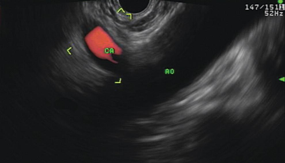 Photo depicts celiac axis (CA) as seen by EUS. AO, aorta.