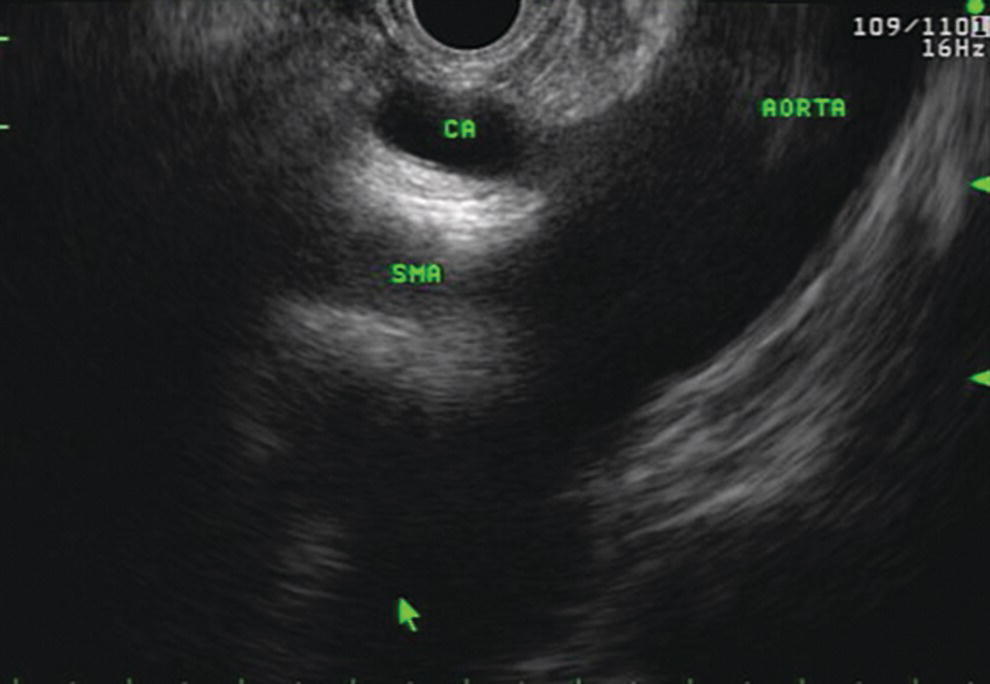 Photo depicts celiac axis confirmed by the aorta, celiac artery (CA) and superior mesenteric artery (SMA).