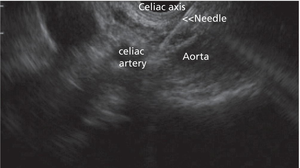 Photo depicts insertion of the EUS-guided fine needle aspiration needle into the area of the celiac axis.