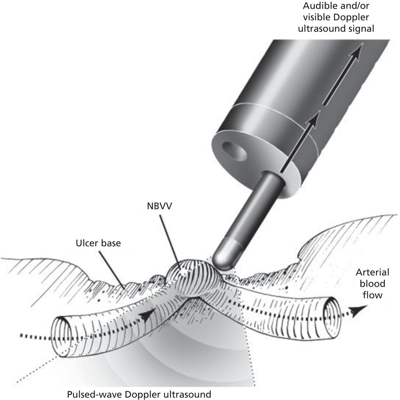 Schematic illustration of a bleeding peptic ulcer with a non-bleeding visible vessel (NBVV) undergoing Doppler ultrasound (DopUS) examination using an endoscopic DopUS probe that was passed via the accessory channel of a standard endoscope.