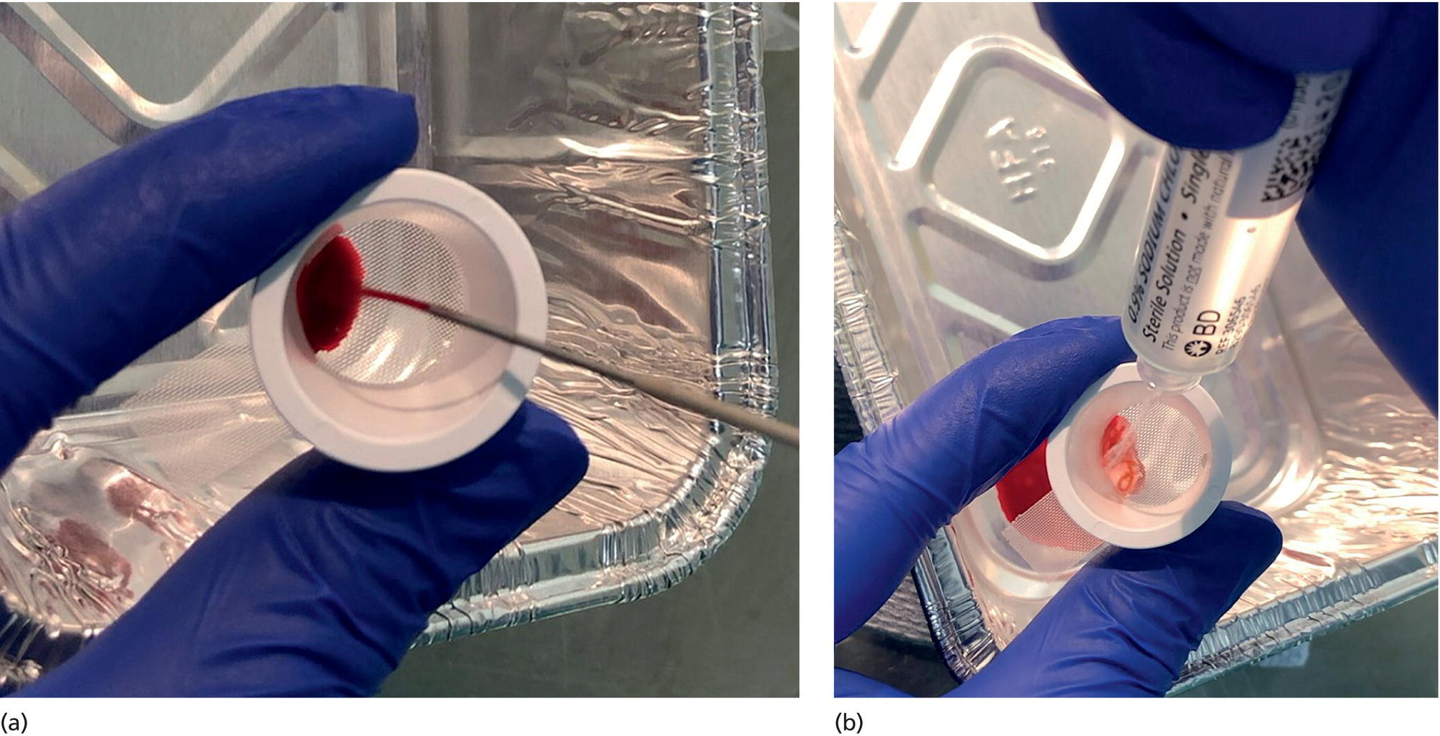 Photos depict (a) Use of tissue sieve to collect specimen from biopsy needle. (b) Core sample is washed with saline to remove blood.