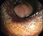 How to do an EUS‐guided Gastrojejunostomy