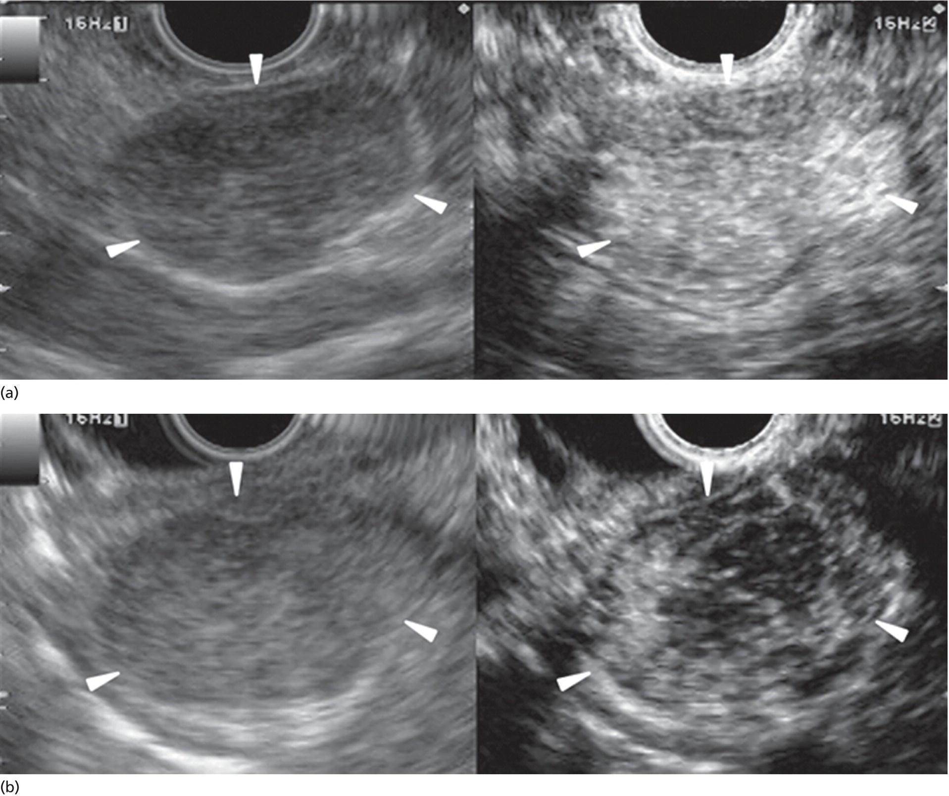 How to do Contrast‐enhanced EUS | Radiology Key