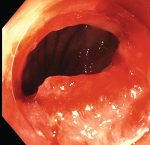 How to Perform Endoscopic Ultrasound‐directed Transgastric Endoscopic Retrograde Cholangiopancreatography (EDGE)