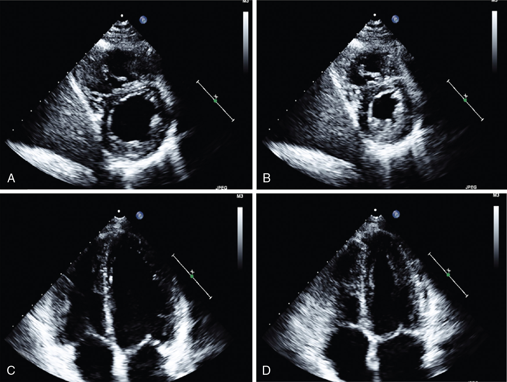 Imaging in patients with acute chest pain in the emergency department ...