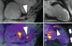 Assessing the biology of high-risk plaque features with molecular imaging