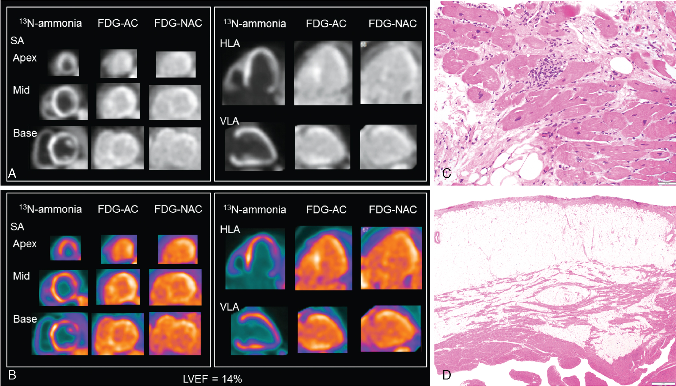 Patient With Known Or Suspected Cardiac Sarcoidosis Radiology Key 1055