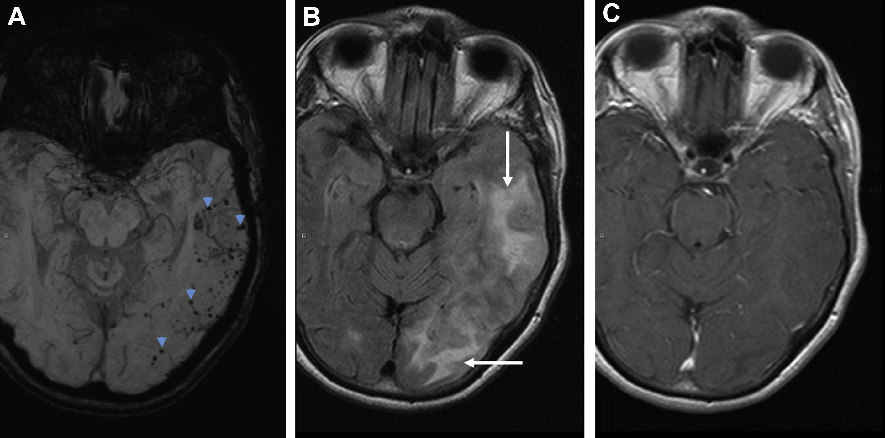 imaging-mimics-of-brain-tumors-radiology-key