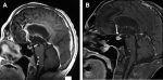 Imaging of Neurologic Injury following Oncologic Therapy