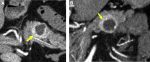Incidental Pancreatic Cysts on Cross-Sectional Imaging