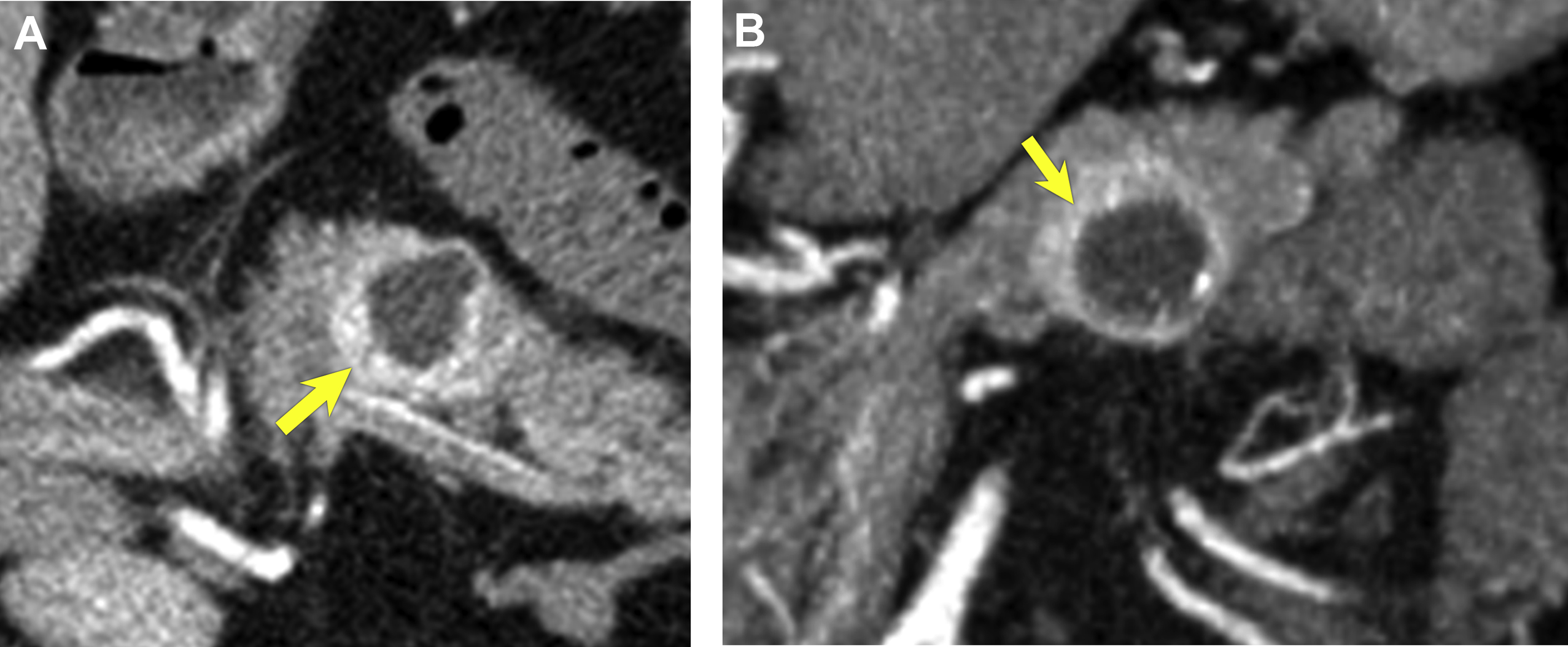 Incidental Pancreatic Cysts On Cross Sectional Imaging Radiology Key Incidental pancreatic cysts on cross sectional imaging radiology key