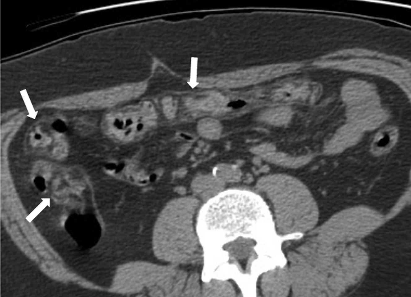 Spectrum And Relevance Of Incidental Bowel Findings On Computed 