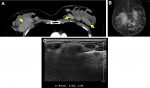 Incidental Breast Findings on Computed Tomography and MR Imaging