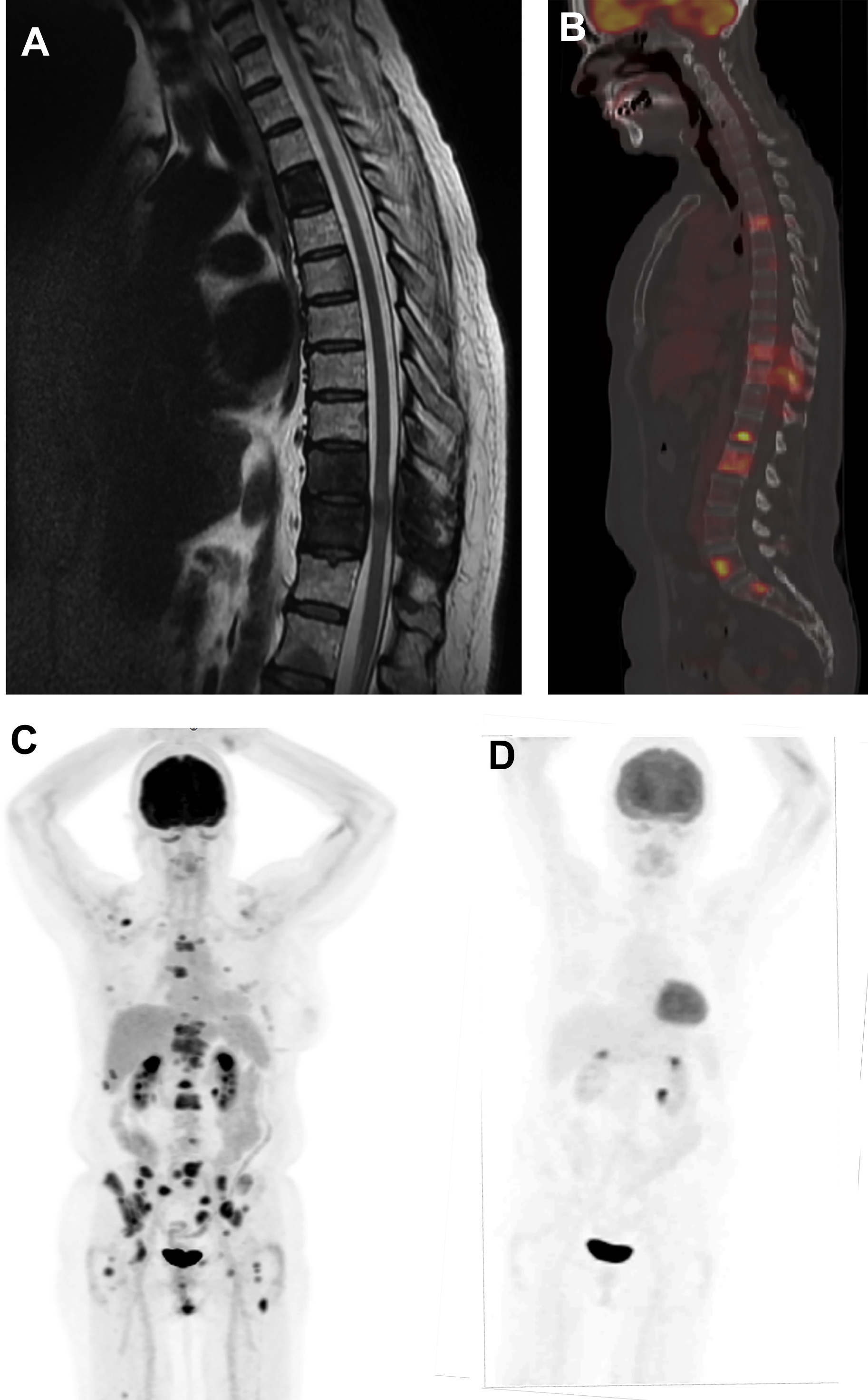 Pet Ct Scan Of A Patient With Breast Cancer A Trace Amount Of | Hot Sex