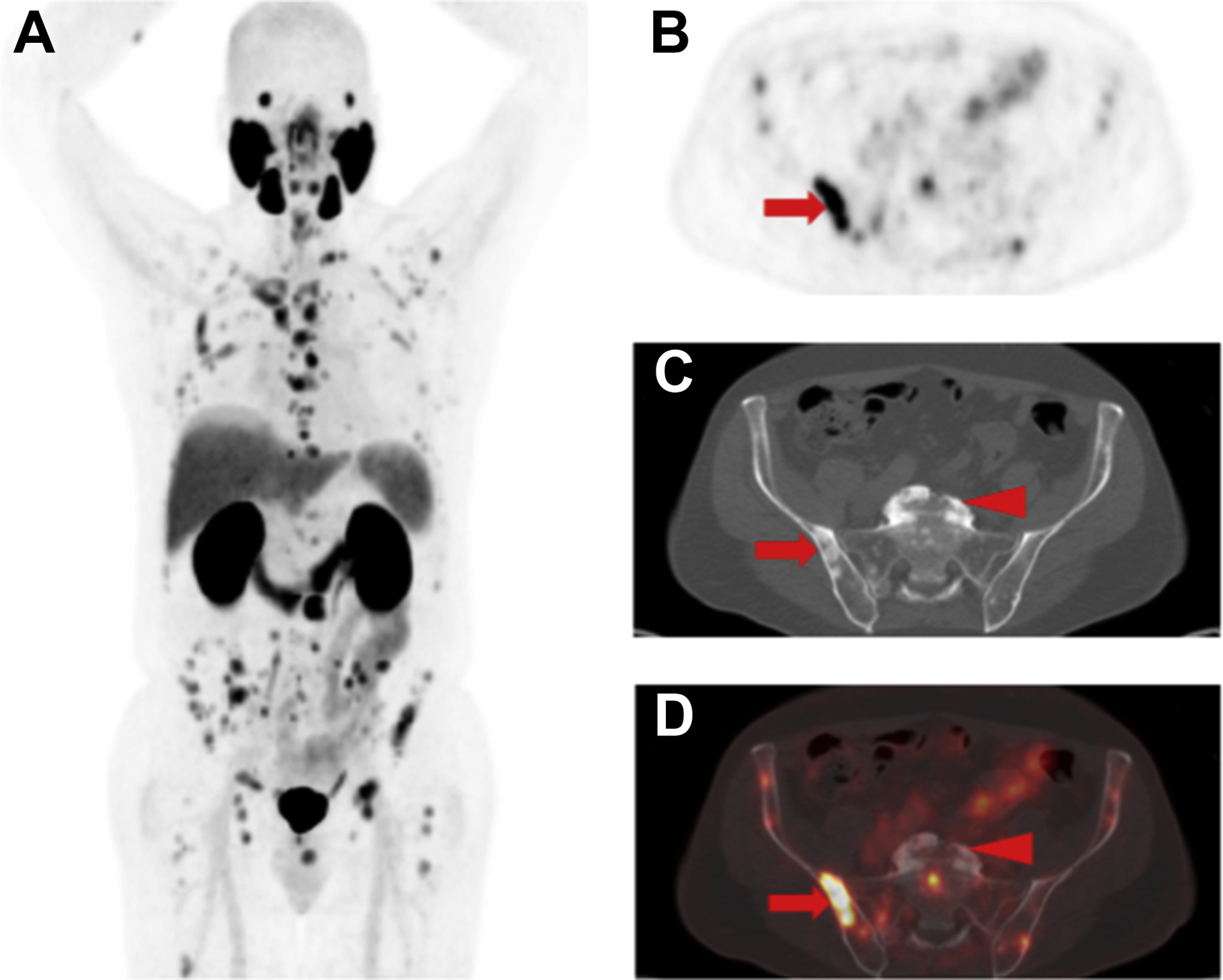 Changes in Management After 18F-DCFPyL PSMA PET in Patients