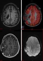 Role of Functional Magnetic Resonance Imaging in the Presurgical Mapping of Brain Tumors