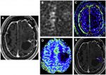 Clinical Review of Computed Tomography and MR Perfusion Imaging in Neuro-Oncology