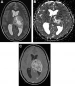 Imaging Findings of New Entities and Patterns in Brain Tumor