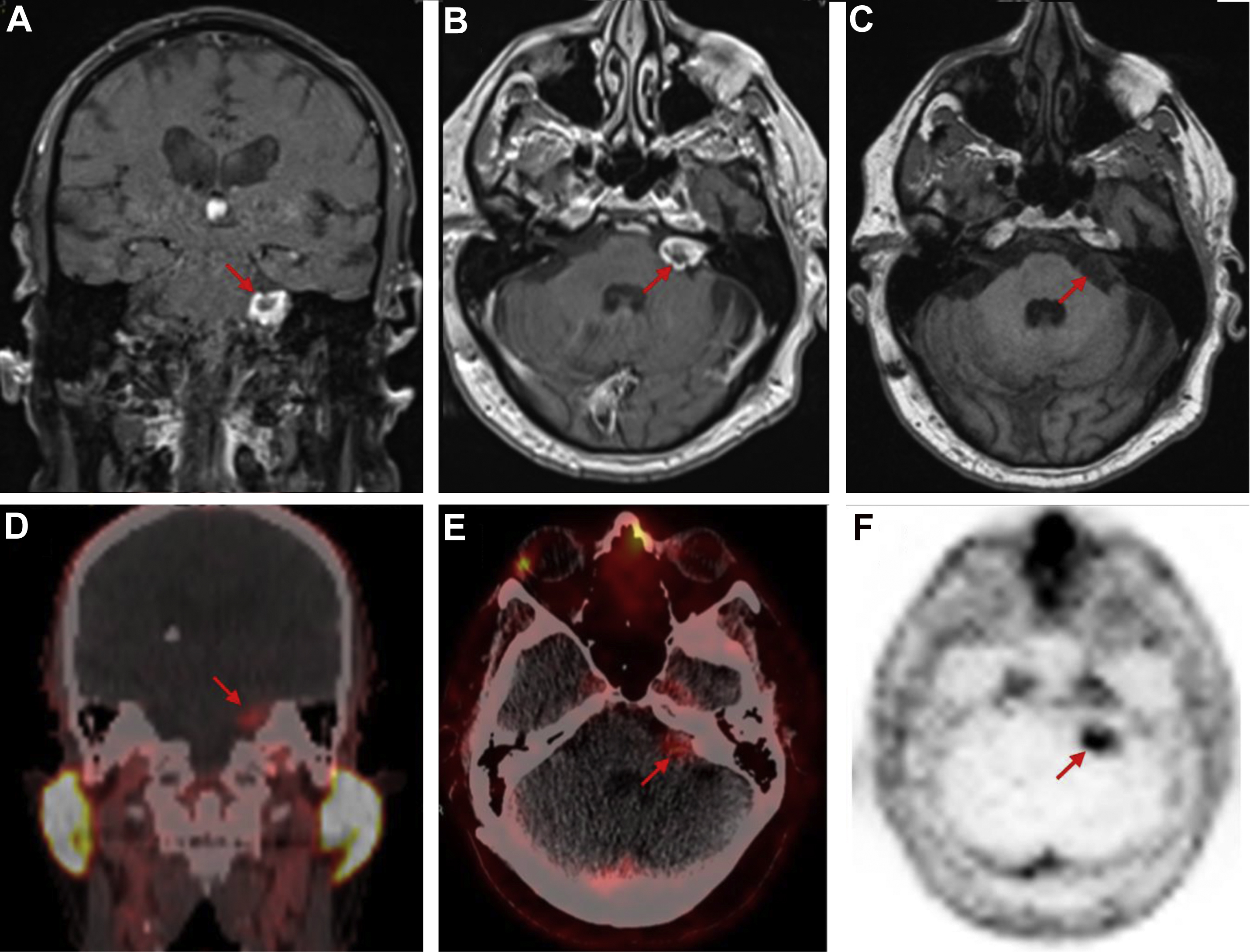 Cellular And Molecular Imaging With Spect And Pet In Brain Tumors