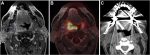 PET Imaging for Head and Neck Cancers