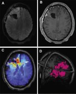 Clinical Applications of Magnetic Resonance Spectroscopy in Brain Tumors