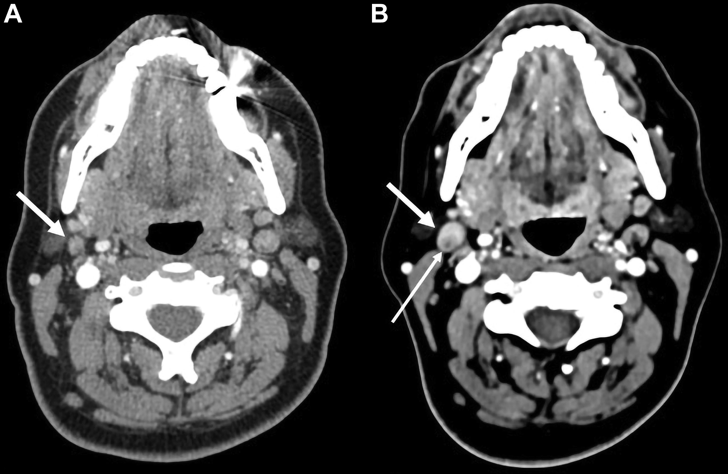 Do Lymph Nodes Swell With Brain Tumor