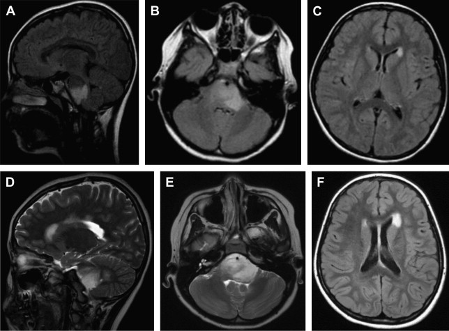 Mimics and Rare Presentations of Pediatric Demyelination | Radiology Key