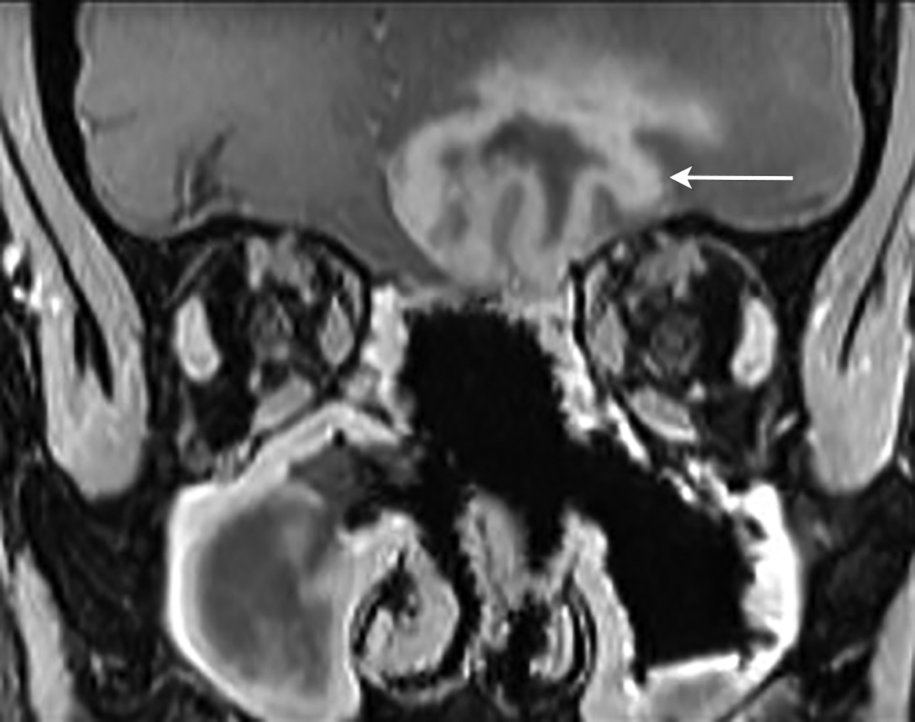 Imaging of the Postoperative Skull Base and Cerebellopontine Angle ...