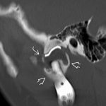 Imaging of the Postoperative Jaws and Temporomandibular Joints