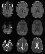 The Magnetic Resonance Imaging Appearance of Monophasic Acute Disseminated Encephalomyelitis