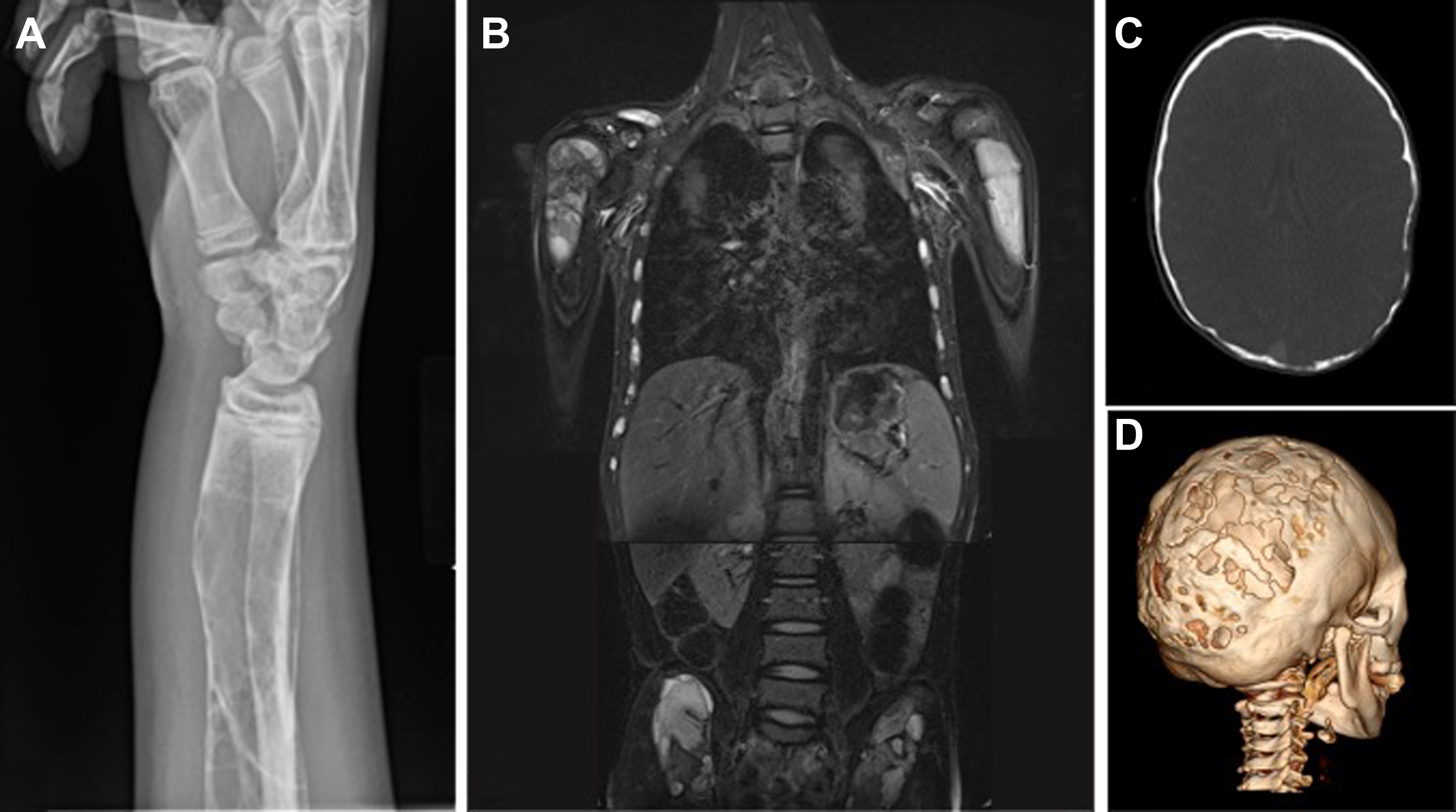 Understanding Vascular Malformations Of The Spine