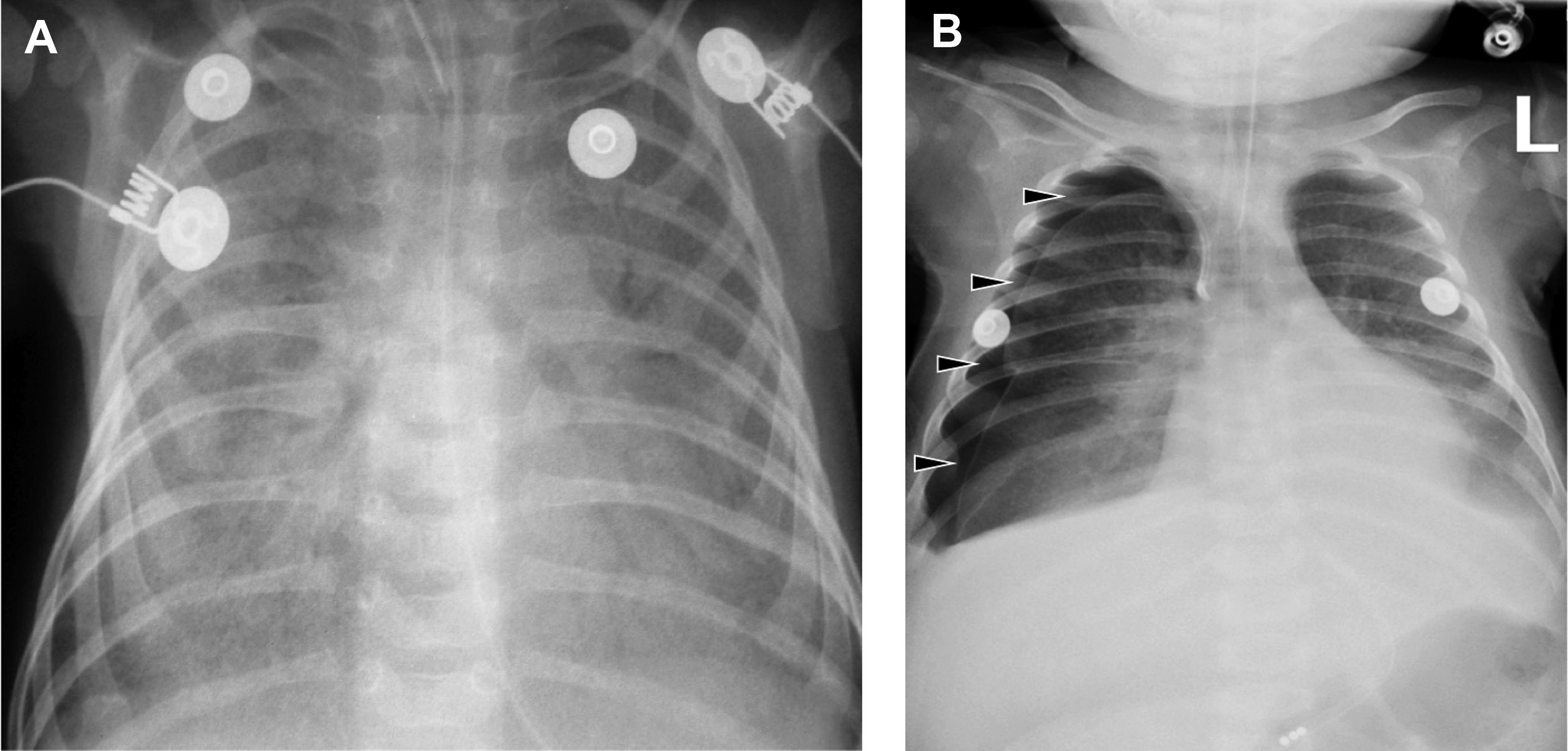 Pediatric Lower Respiratory Tract Infections Radiology Key