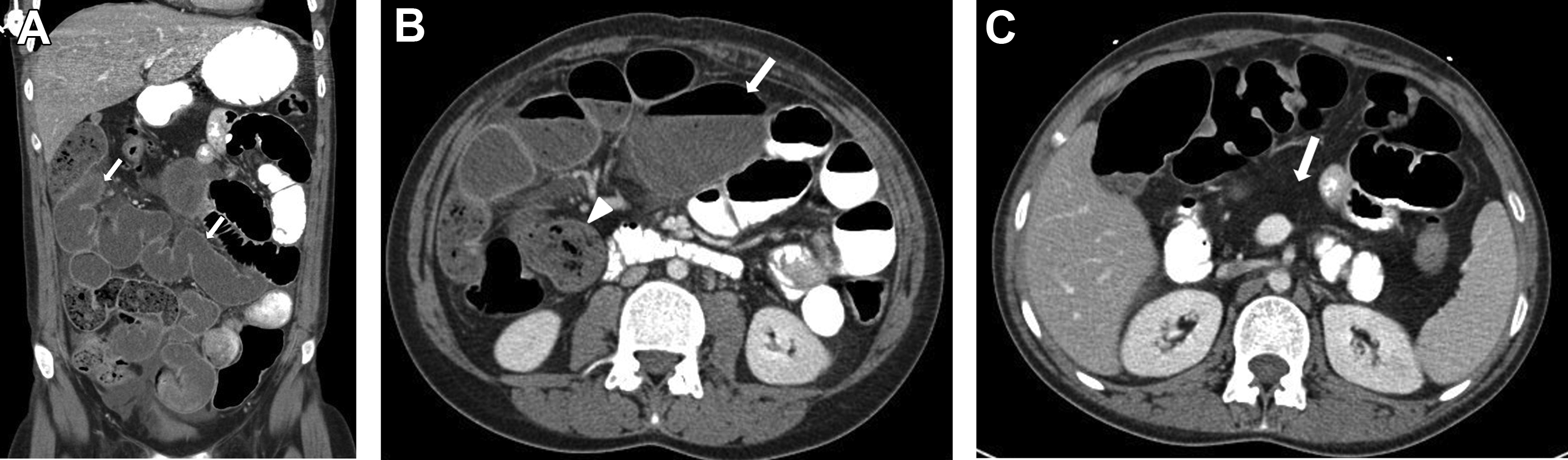 Neonatal And Pediatric Bowel Obstruction | Radiology Key