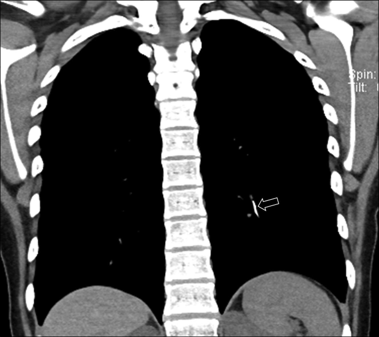 Pediatric Pulmonary Embolism Radiology Key