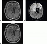Imaging Modalities for Central Nervous System Tumors