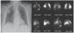 Pulmonary Scintigraphy
