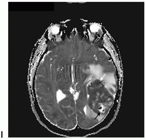 Other Gliomas | Radiology Key