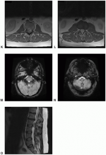 Neuronal and Mixed Glioneuronal Tumors