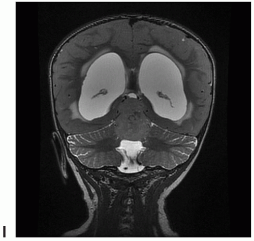 Tumors of the Pineal Region | Radiology Key